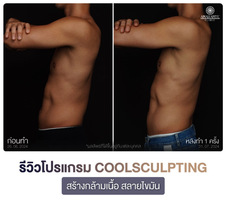 ภาพรีวิว CoolSculpting สร้างกร้ามเนื้อ สลายไขมัน เคสลูกค้าผู้ชาย มุมข้าง