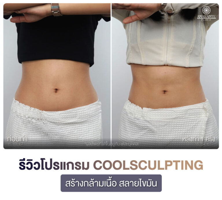 ภาพรีวิว CoolSculpting สร้างกร้ามเนื้อ สลายไขมัน เคสลูกค้าผู้หญิง มุมตรง