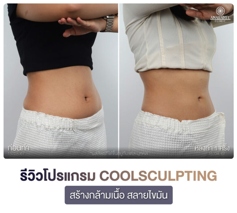 ภาพรีวิว CoolSculpting สร้างกร้ามเนื้อ สลายไขมัน เคสลูกค้าผู้หญิง มุม 45 องศา