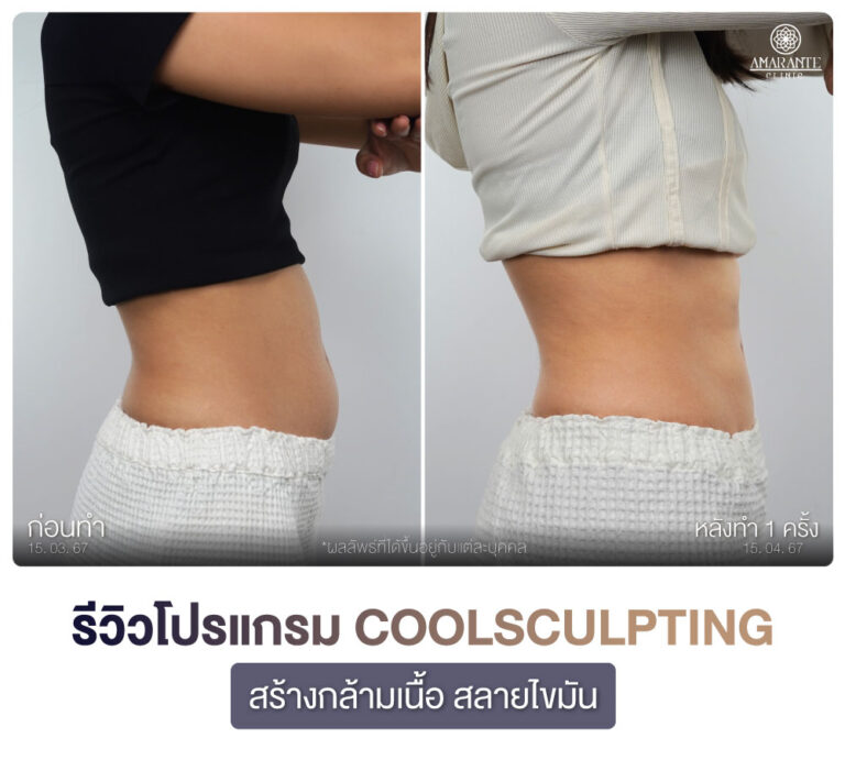 ภาพรีวิว CoolSculpting สร้างกร้ามเนื้อ สลายไขมัน เคสลูกค้าผู้หญิง มุมข้าง