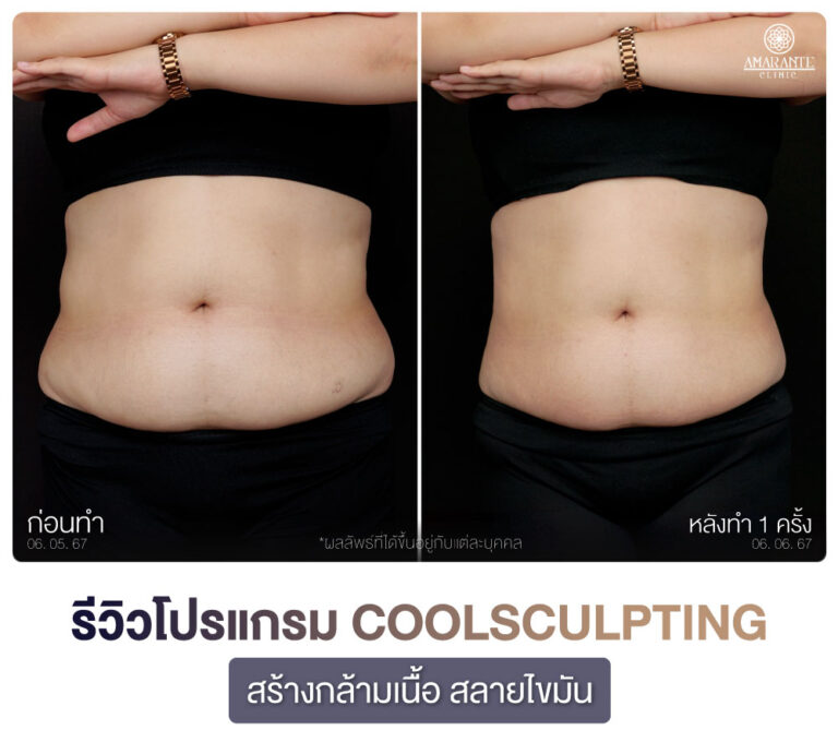 ภาพรีวิว CoolSculpting สร้างกร้ามเนื้อ สลายไขมัน เคสลูกค้าผู้หญิงคนที่สอง มุมตรง