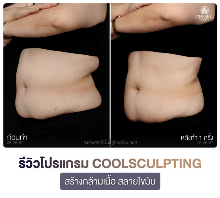 ภาพรีวิว CoolSculpting สร้างกร้ามเนื้อ สลายไขมัน เคสลูกค้าผู้หญิงคนที่สอง มุม 45 องศา