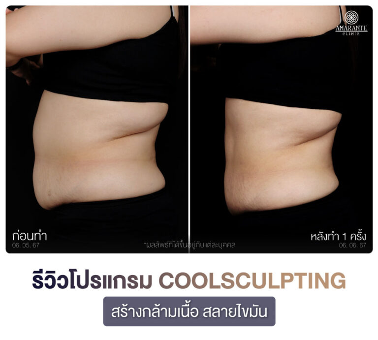ภาพรีวิว CoolSculpting สร้างกร้ามเนื้อ สลายไขมัน เคสลูกค้าผู้หญิงคนที่สอง มุมข้าง
