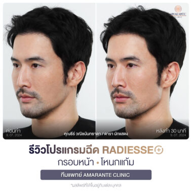 ภาพรีวิวโปรแกรมฉีด Radiesse Plus Before and After มุมหน้า 45 องศา คุณธีร์
