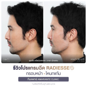 ภาพรีวิวโปรแกรมฉีด Radiesse Plus Before and After มุมข้าง คุณธีร์
