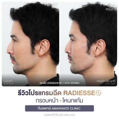 ภาพรีวิวโปรแกรมฉีด Radiesse Plus Before and After มุมข้าง คุณธีร์
