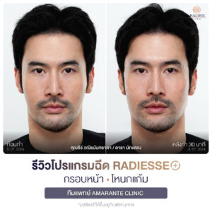 ภาพรีวิวโปรแกรมฉีด Radiesse Plus Before and After หน้าตรง คุณธีร์