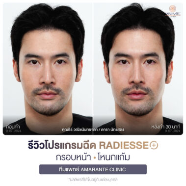 ภาพรีวิวโปรแกรมฉีด Radiesse Plus Before and After หน้าตรง คุณธีร์