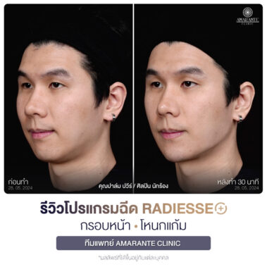 ภาพรีวิวโปรแกรมฉีด Radiesse Plus Before and After มุมซ้าย 45 องศา คุณปาล์ม
