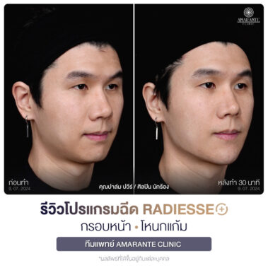 ภาพรีวิวโปรแกรมฉีด Radiesse Plus Before and After มุมขวา 45 องศา คุณปาล์ม