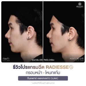 ภาพรีวิวโปรแกรมฉีด Radiesse Plus Before and After มุมข้าง คุณปาล์ม