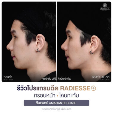 ภาพรีวิวโปรแกรมฉีด Radiesse Plus Before and After มุมข้าง คุณปาล์ม