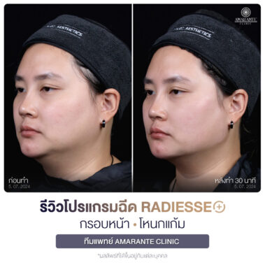 ภาพรีวิวโปรแกรมฉีด Radiesse Plus Before and After มุม 45 องศา ลูกค้าผู้หญิง 1