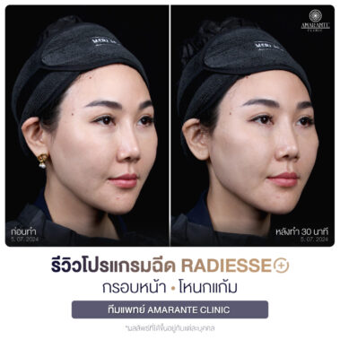 ภาพรีวิวโปรแกรมฉีด Radiesse Plus Before and After มุม 45 องศา ลูกค้าผู้หญิง 2