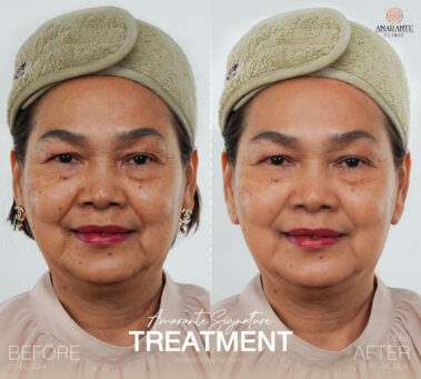 ภาพ before and after นวดหน้า biologique recherche ลูกค้าผู้หญิง 1