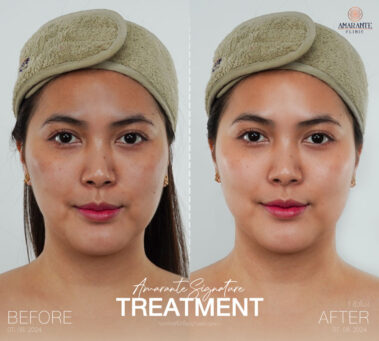 ภาพ before and after นวดหน้า biologique recherche ลูกค้าผู้หญิง 2