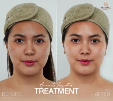 ภาพ before and after นวดหน้า biologique recherche ลูกค้าผู้หญิง 2