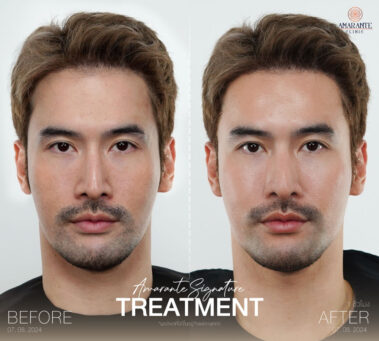 ภาพ before and after นวดหน้า biologique recherche คุณธีร์