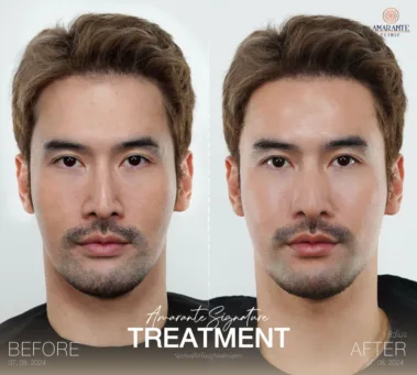ภาพ before and after นวดหน้า biologique recherche คุณธีร์