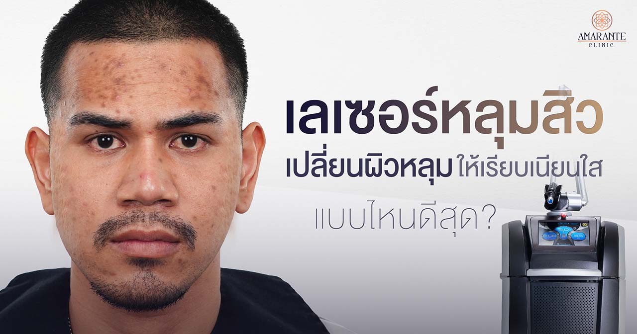 เจาะลึก “เลเซอร์หลุมสิว” เปลี่ยนผิวหลุมให้เรียบเนียนใส แบบไหนดีสุด