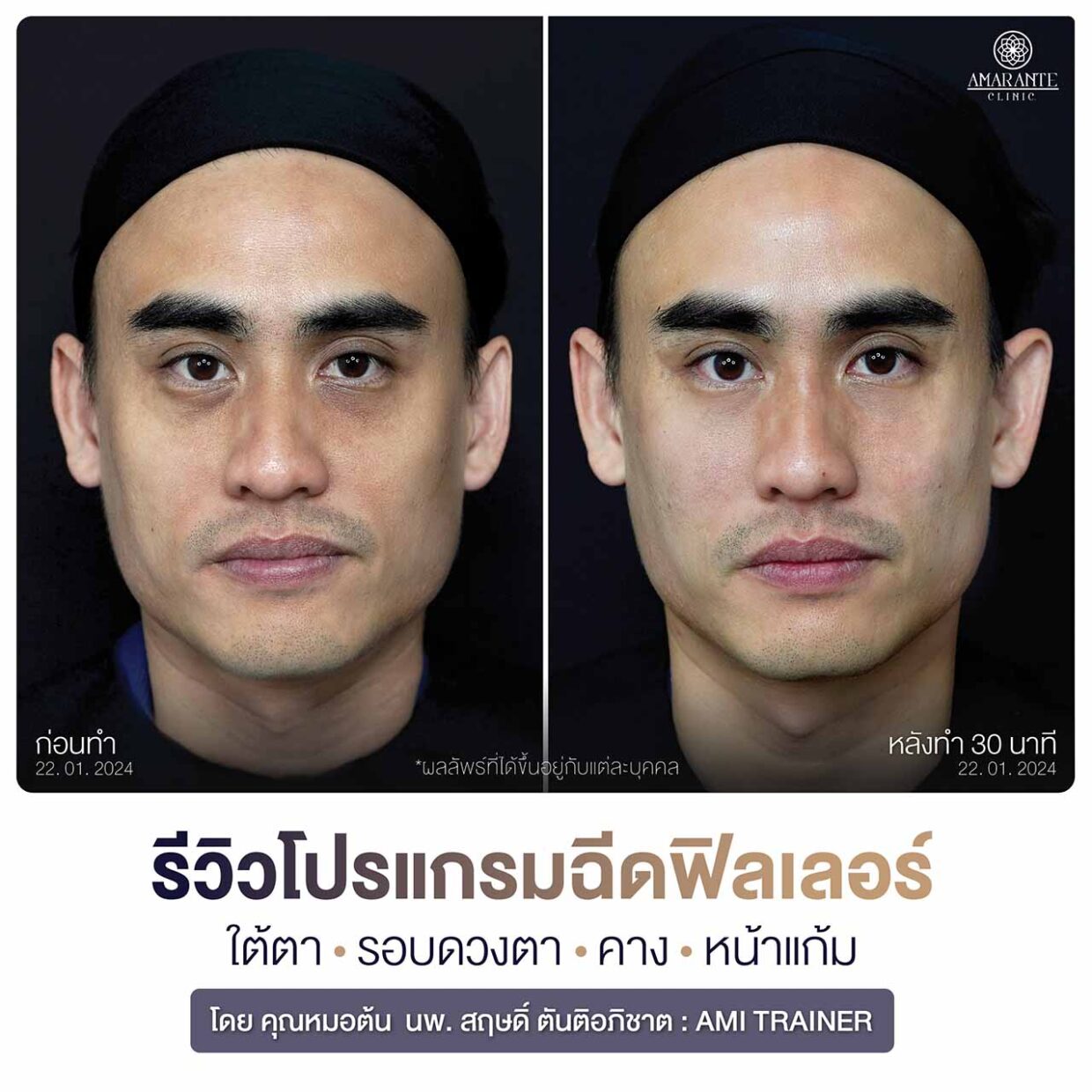 รีวิวฉีดฟิลเลอร์ใต้ตา คาง หน้าแก้ม รูปก่อน-หลัง ผู้ชาย