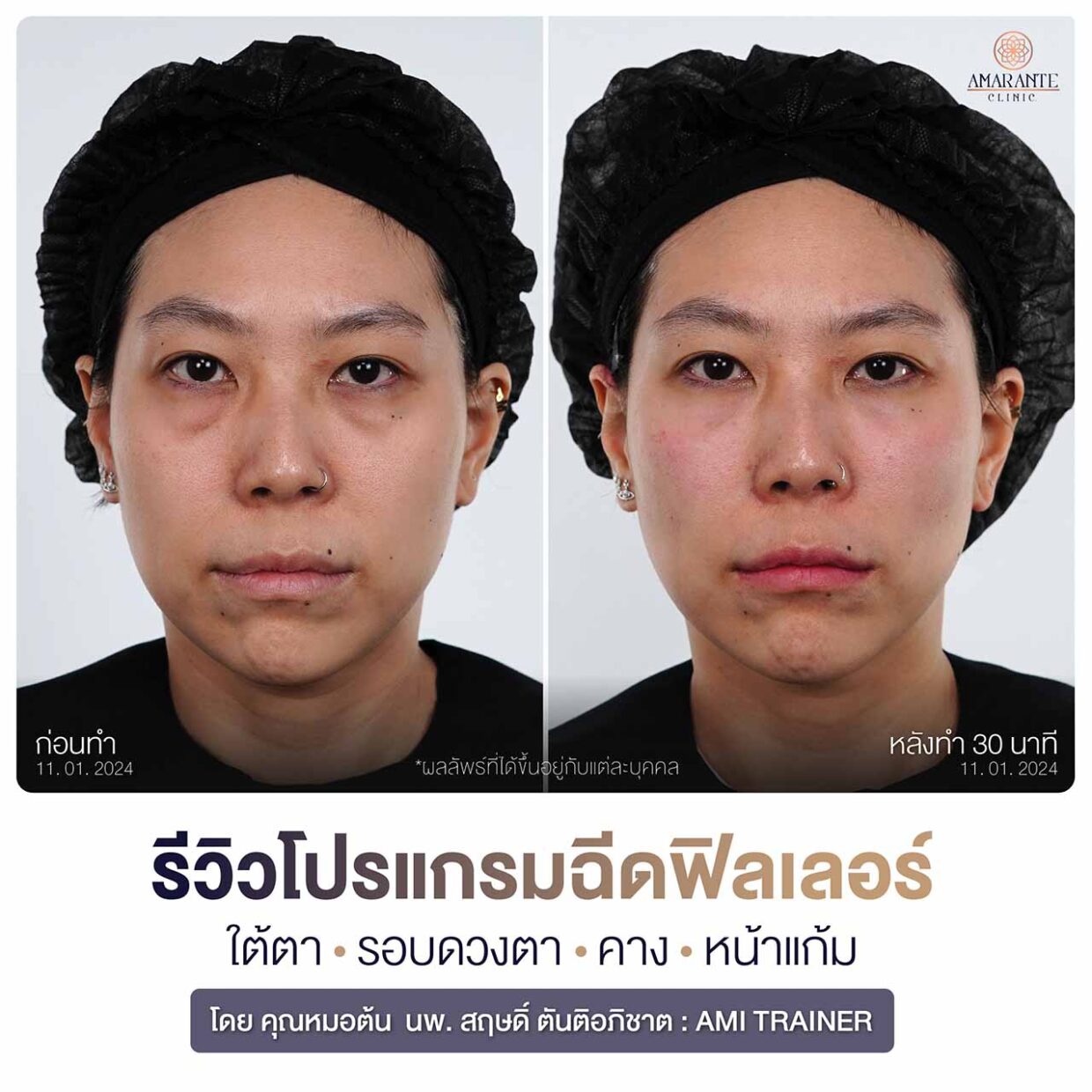 ภาพรีวิวฉีดฟิลเลอร์ใต้ตา คาง และหน้าแก้ม โดย Amarante Clinic