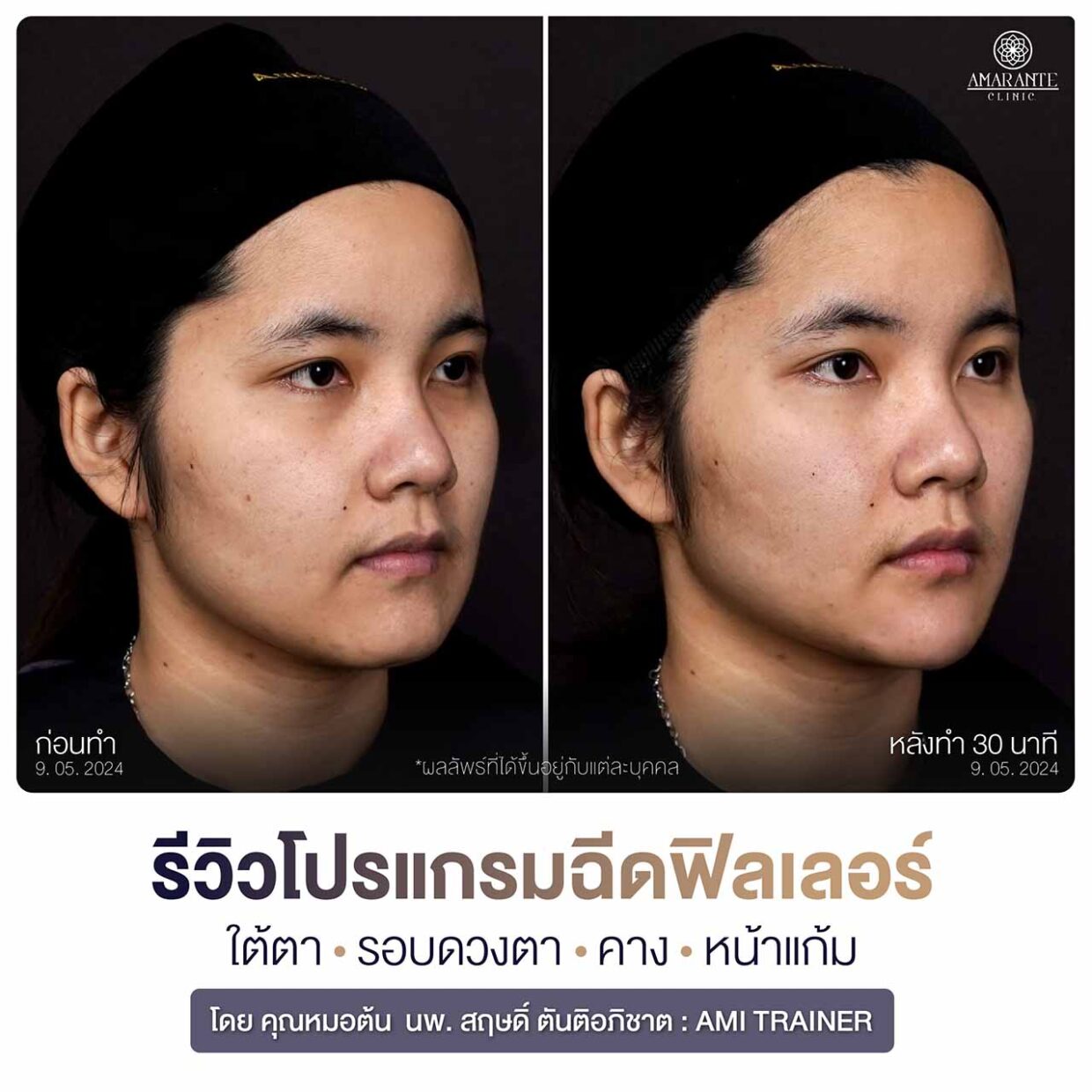 รูปรีวิว ฉีดฟิลเลอร์ใต้ตา คาง หน้าแก้ม ผลลัพธ์เป็นอย่างไร