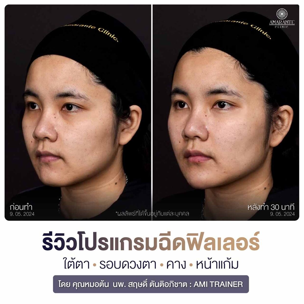 ภาพถ่ายรีวิว ฉีดฟิลเลอร์ใต้ตา คาง หน้าแก้ม เห็นผลจริงไหม