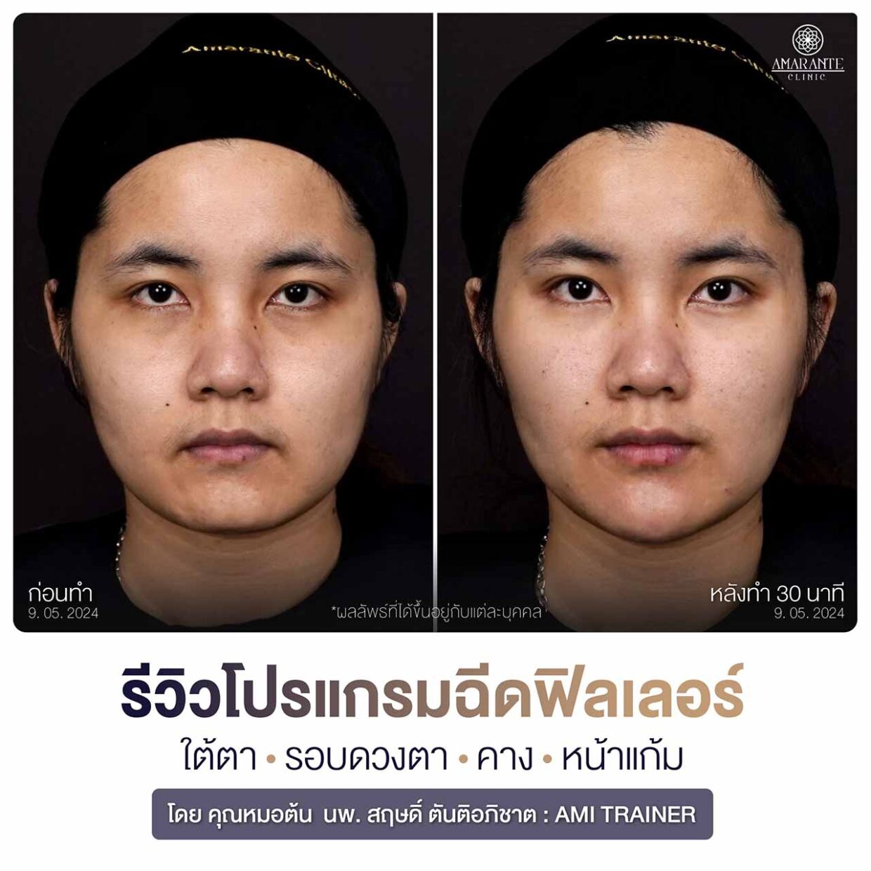 รีวิวโปรแกรมฟิลเลอร์ รอบดวงตา คาง ใต้ตา แก้มส้ม