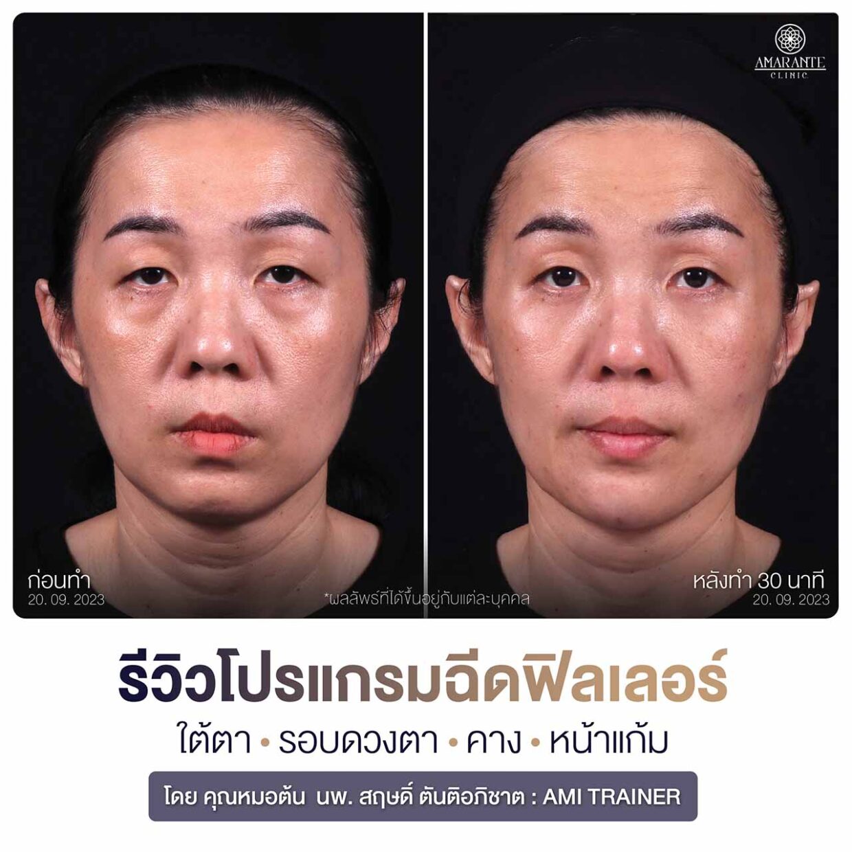 รีวิวฟิลเลอร์ใต้ตา คาง หน้าแก้ม รูปก่อน-หลัง ผู้หญิง