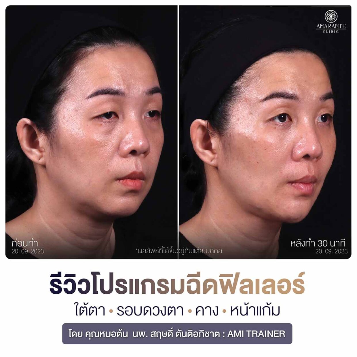 รูปเปรียบเทียบก่อน-หลัง รีวิวฉีดฟิลเลอร์คาง หน้าแก้ม ใต้ตา