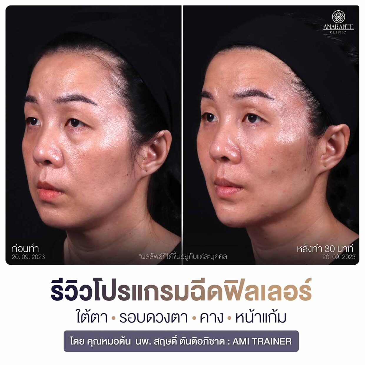รีวิวโปรแกรมฉีดฟิลเลอร์หน้าแก้ม คาง ใต้ตา รอบดวงตา