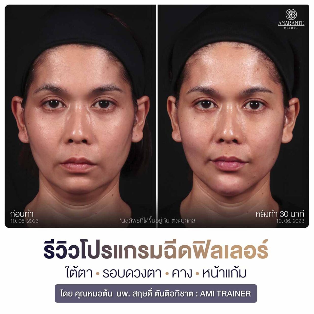 รีวิวฉีดฟิลเลอร์หน้าแก้ม คาง ใต้ตา รอบดวงตา โดยคุณหมอต้น แพทย์ระดับ AMI Trainer