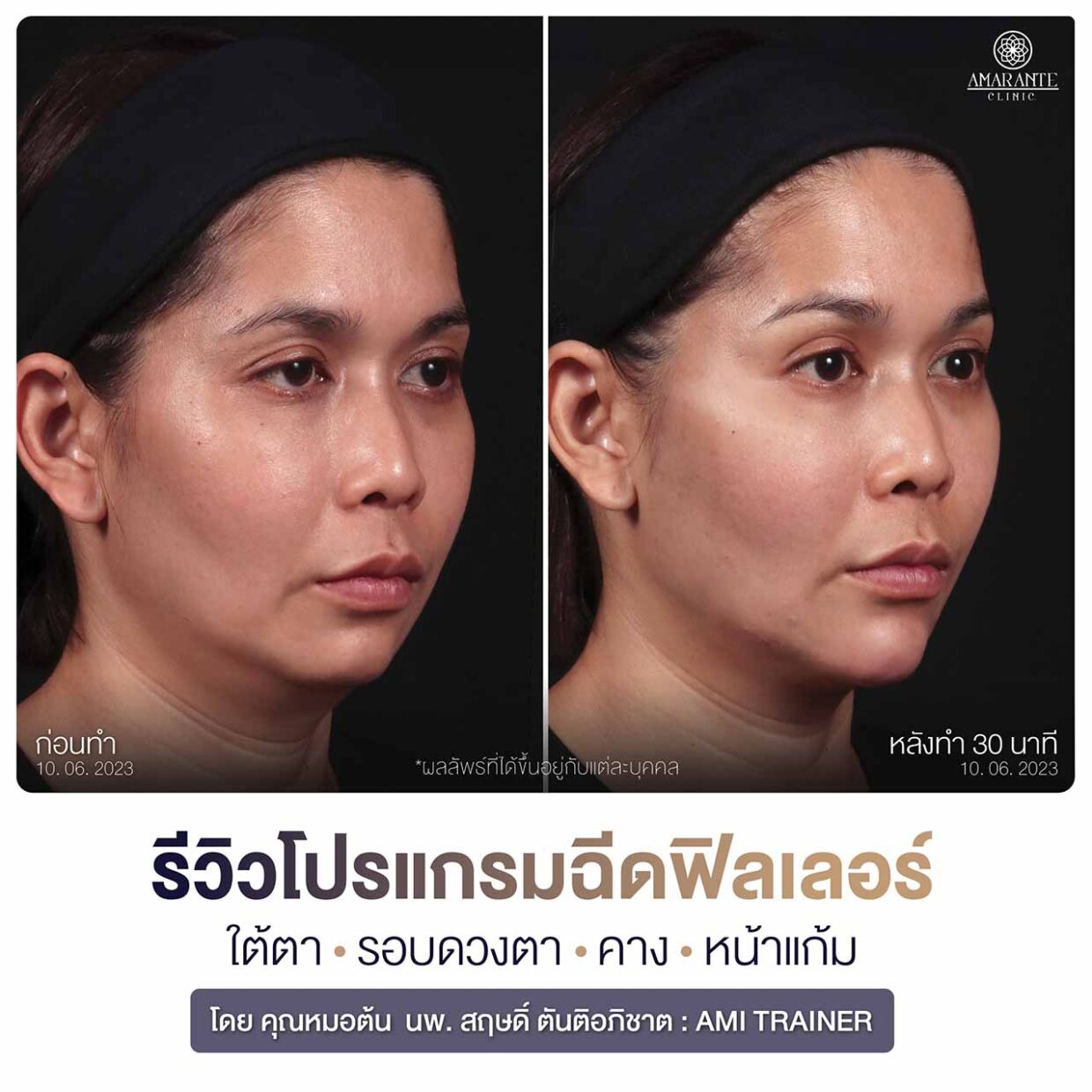 รีวิวฉีดฟิลเลอร์ใต้ตา หน้าแก้ม คาง โดยคุณหมอต้น นพ. สฤษดิ์ ตันติอภิชาต