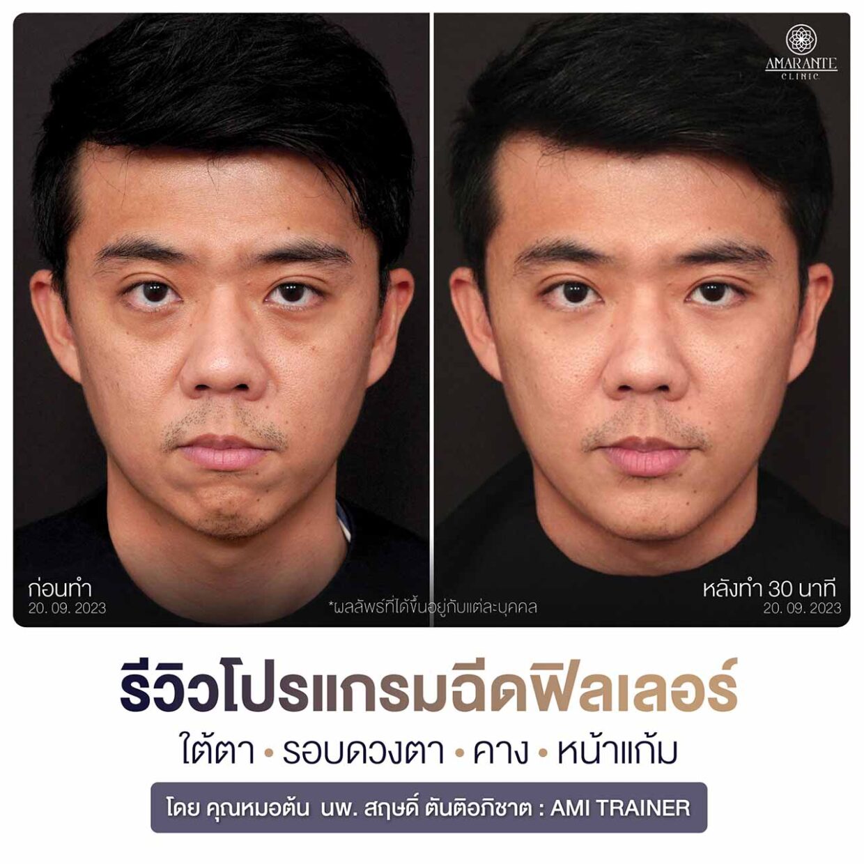 รีวิวฉีดฟิลเลอร์ใต้ตา หน้าแก้ม คาง ภาพถ่ายหน้าตรง เปรียบเทียบก่อนและหลัง