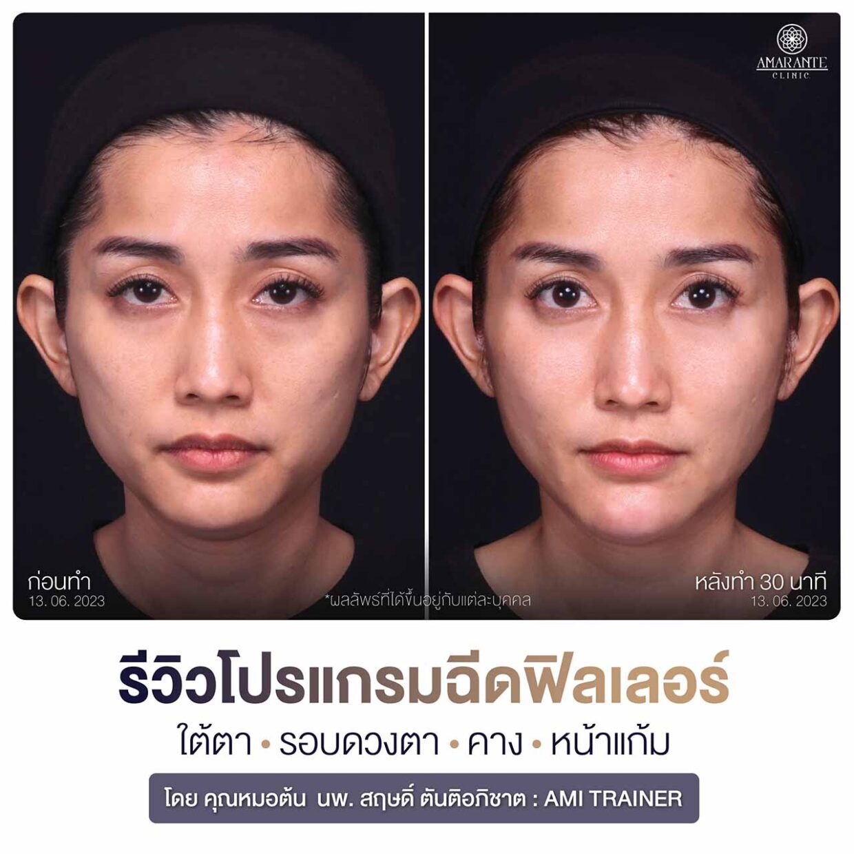 รีวิวฉีดฟิลเลอร์คาง ใต้ตา หน้าแก้ม ภาพถ่ายหน้าตรง หลังทำ 30 นาที