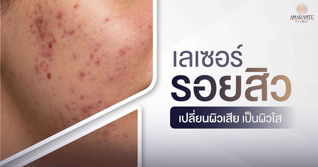 เลเซอร์รอยสิว จากผิวเสียเป็นผิวใส แบบไหนเหมาะกับคุณ
