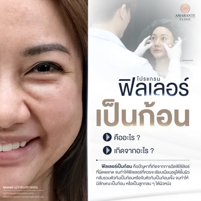 ฟิลเลอร์เป็นก้อนคืออะไร เกิดจากอะไร