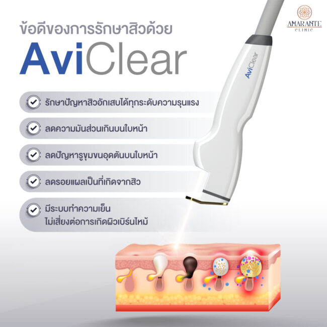 ข้อดีของการรักษาสิวด้วย-AviClear