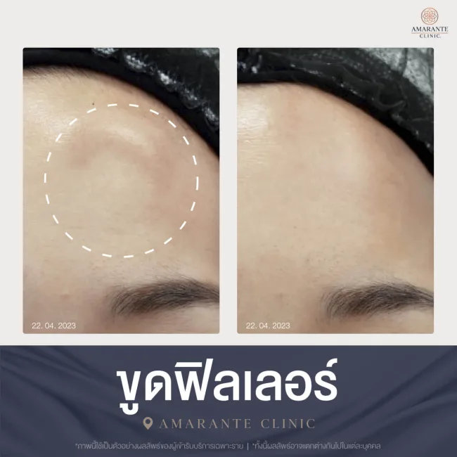 ขูดฟิลเลอร์ หน้าผาก