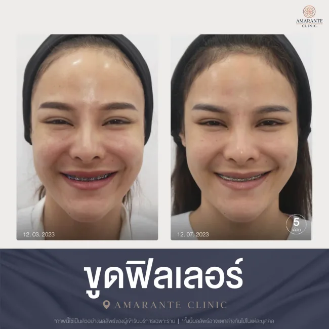 ขูดฟิลเลอร์ คุณผู้หญิง ยิ้ม