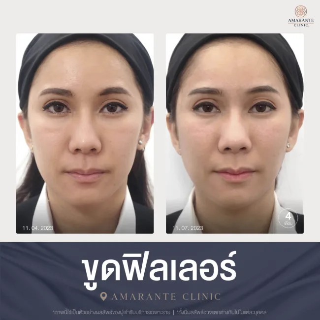 ขูดฟิลเลอร์คุณผู้หญิง ไม่ยิ้ม