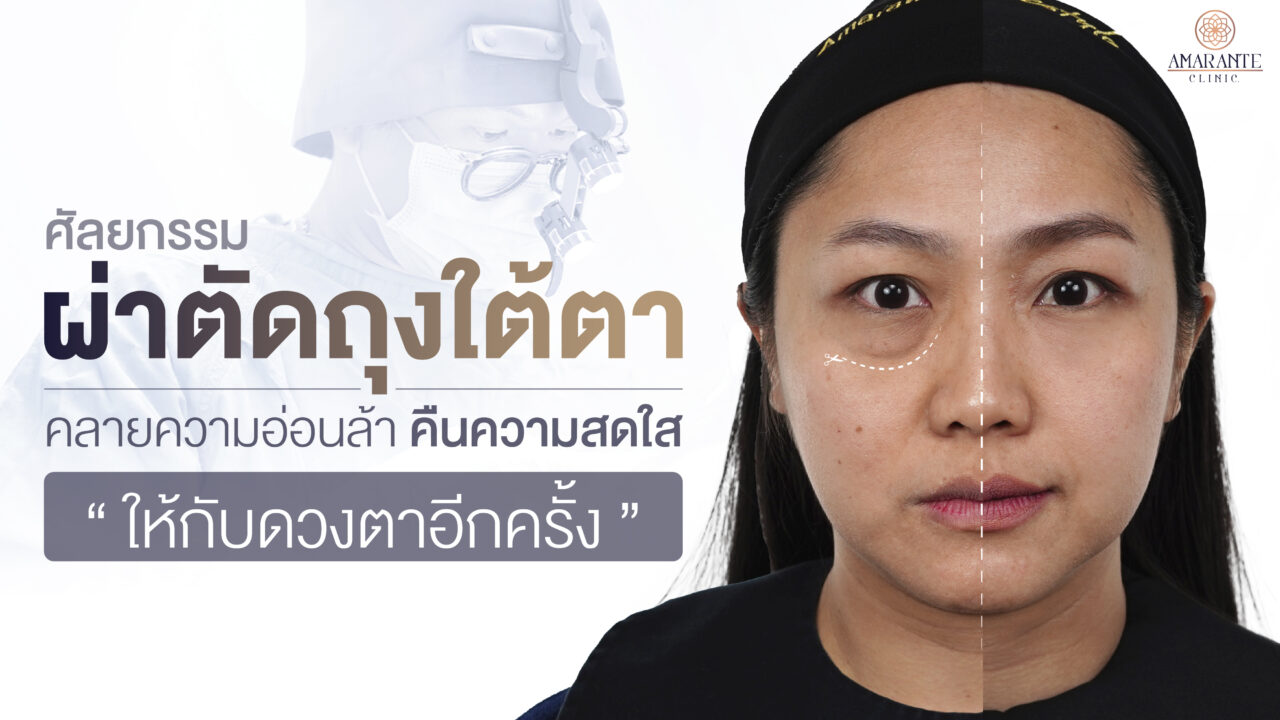 ปกภาพของหน้า ศัลยกรรม ผ่าตัดถุงใต้ตา คลายความอ่อนล้า คืนความสดใสให้กับดวงตาอีกครั้ง