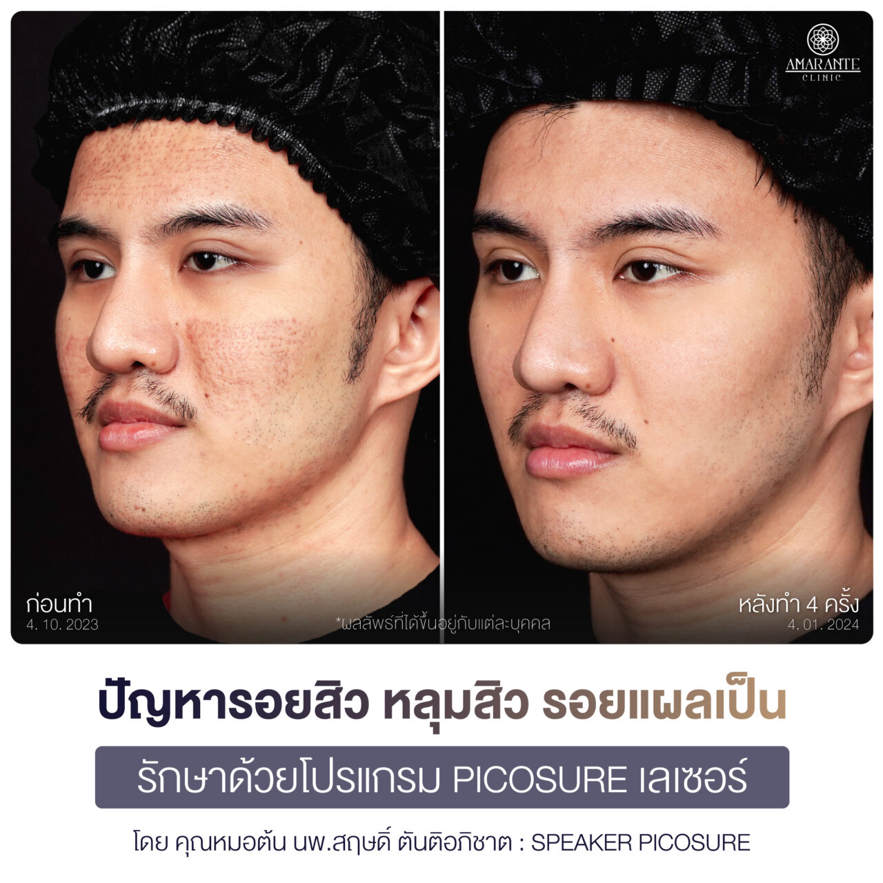 ภาพรีวิว Pico Laser ก่อนทำและหลังทำ คุณโตโต้มุมหันซ้าย 45 องศา
