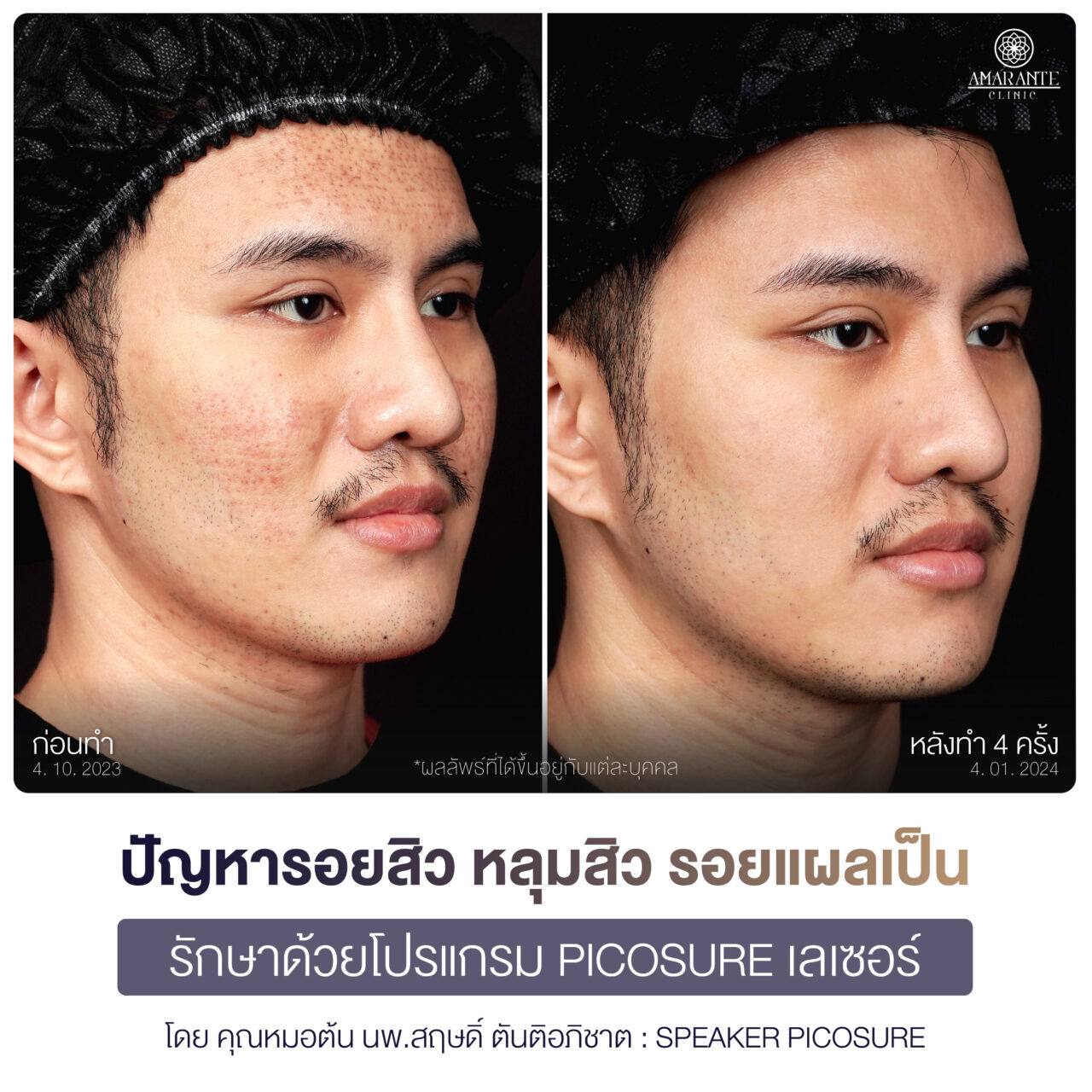 ภาพรีวิว Pico Laser ก่อนทำและหลังทำ คุณโตโต้มุมหันขวา 45 องศา