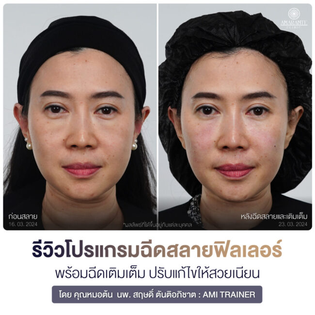 ภาพหน้านิ่งตรง Before and After ก่อนสลายและหลังฉีดสลายบวกเติมเต็ม - คุณแนน ภาพ ฉีดสลาย filler ใต้ตา รีวิว คุณแนน หน้าตรง หน้านิ่ง