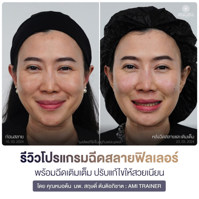 ภาพหน้ายิ้มตรง Before and After ก่อนสลายและหลังฉีดสลายบวกเติมเต็ม - คุณแนน