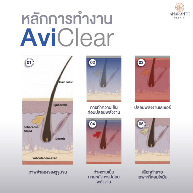 หลักการทำงาน AviClear