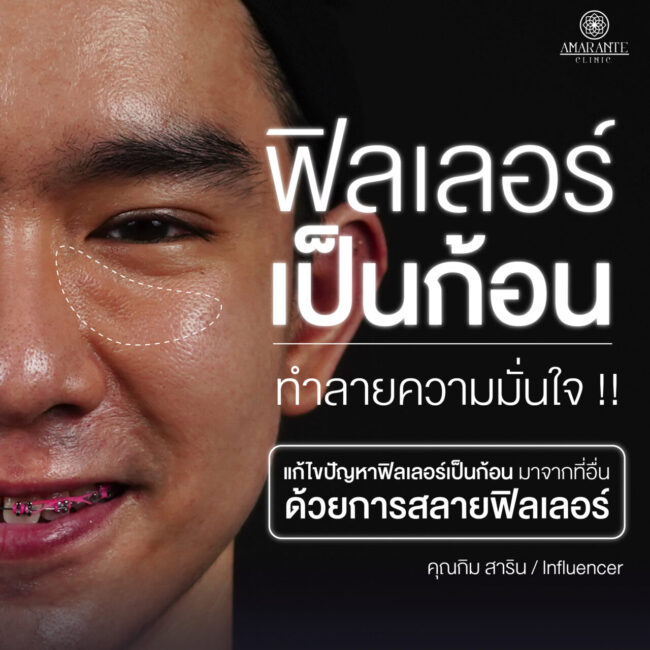 ภาพประกอบปัญหาฟิลเลอร์เป็นก้อนในบริเวณใต้ตาของคุณกิม