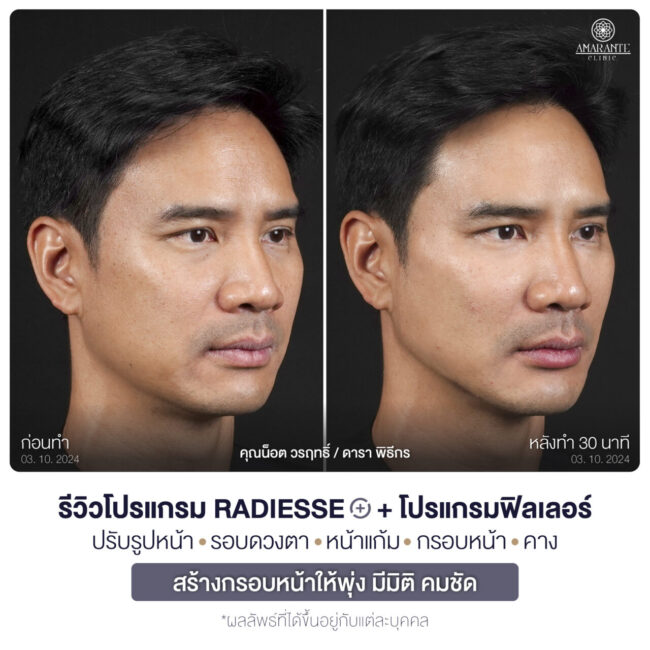 ภาพ BA คุณน๊อต หันขวา 45 องศา